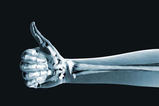 Röntgenaufnahmen können bei der Diagnose von Fingergelenkschmerzen helfen. 