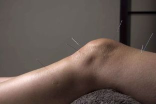 Akupunktur fördert die Reparatur von Gelenkgewebe