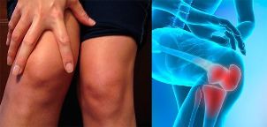 Beschwerden und Schwellungen im Kniebereich sind die ersten Symptome einer Arthrose. 