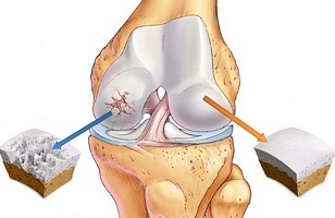 Ursachen für Arthrose des Kniegelenks